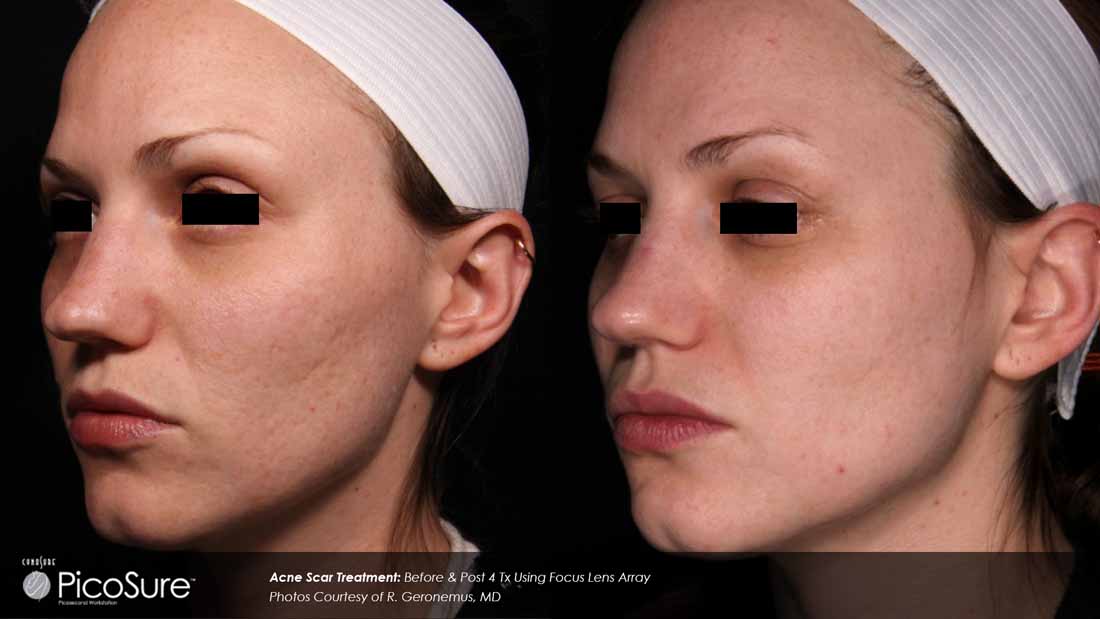 Acne Scar Removal