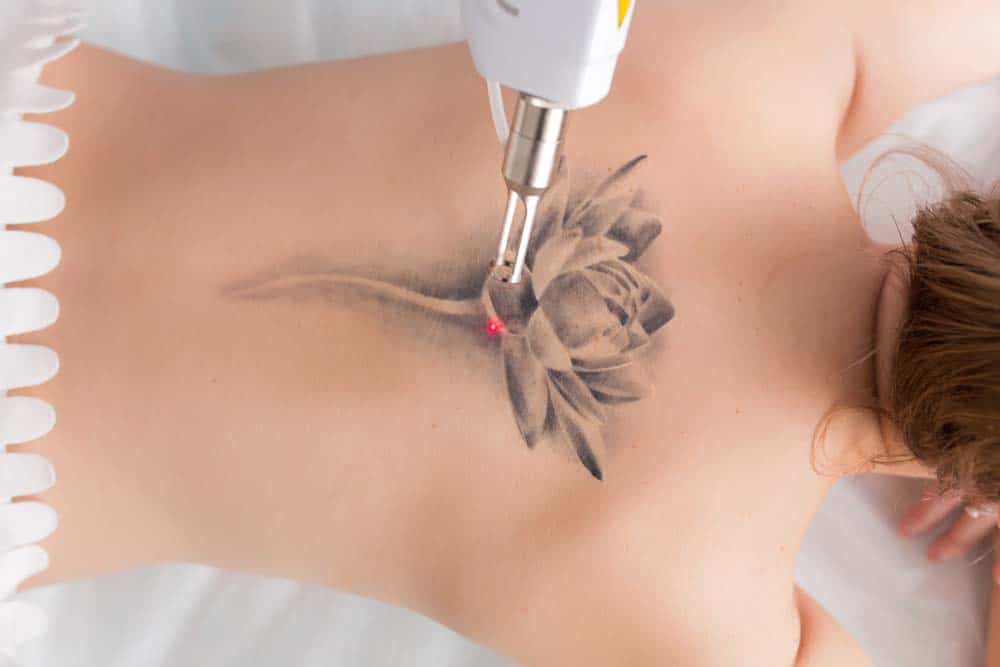 Best Tattoo Removal Clinic in Sydney | Laser Tattoo Removal